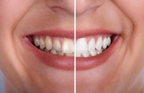 risultati ottenuti con lo sbiancamento denti domiciliare con mascherina