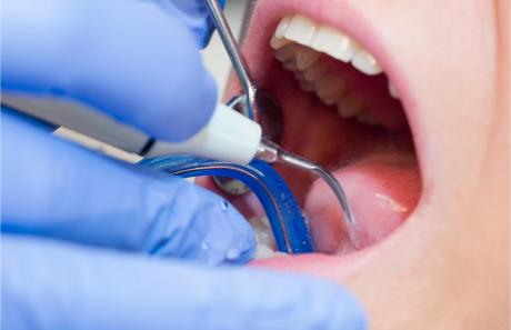 trattamento di igiene orale professionale eseguito nello studio odontoiatrico da un'igienista dentale