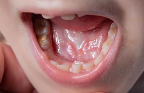 denti da squalo nei bambini