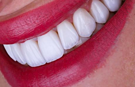 estetica del sorriso: denti bianchi e brillanti con faccette dentali