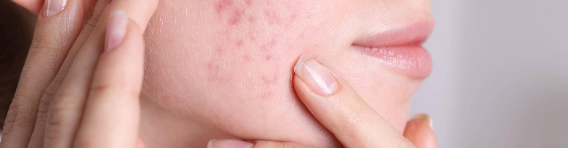 acne in età adulta