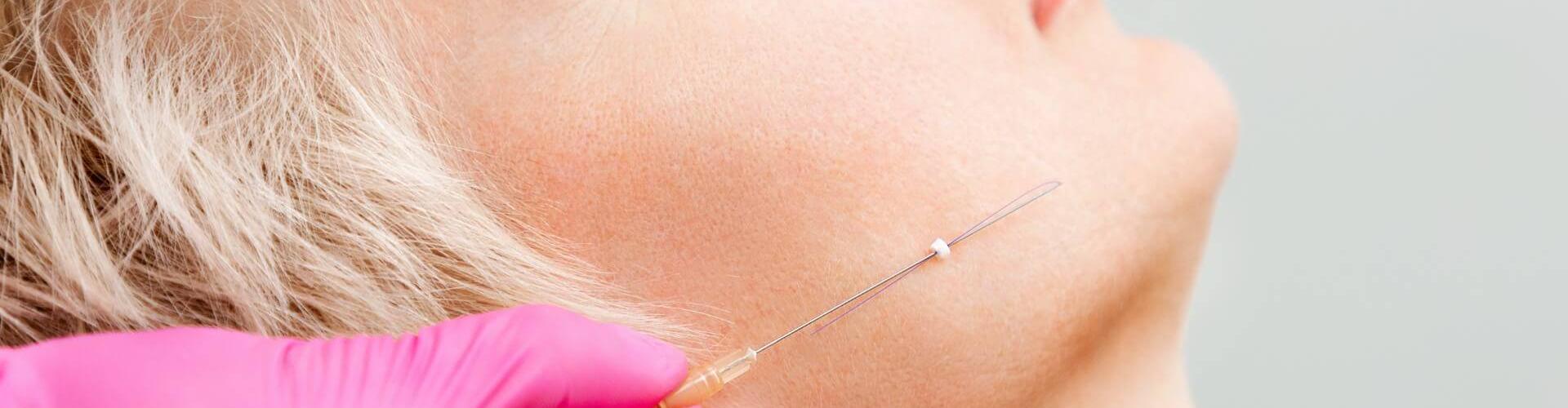lifting viso non chirurgico con fili biostimolanti