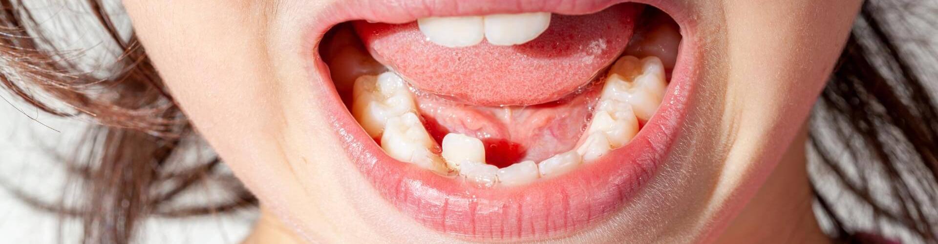 denti storti nei bambini