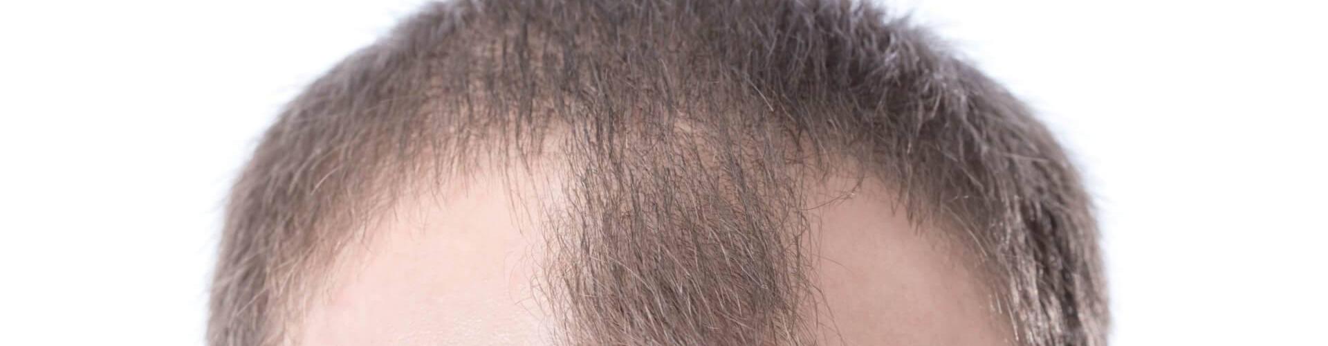 perdita di capelli in giovane età