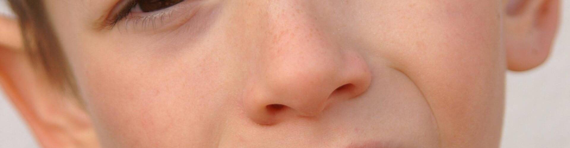 bambino con dente scheggiato in seguito a un trauma dentale