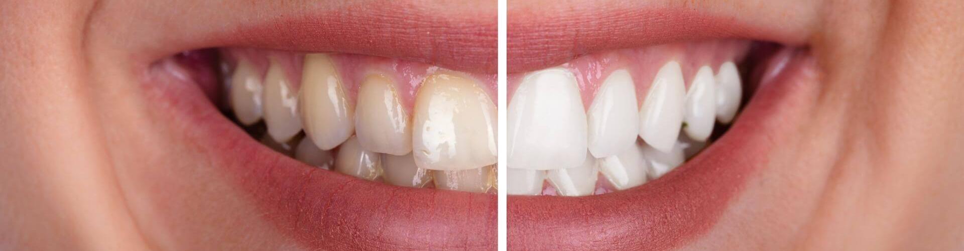 denti prima e dopo lo sbiancamento dentale domiciliare