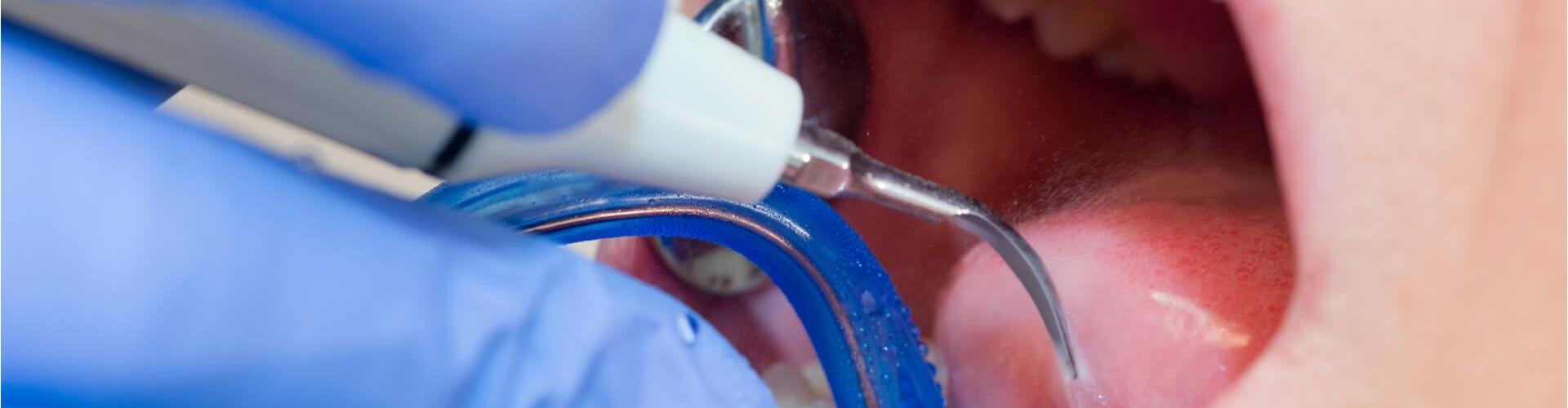 ablazione del tartaro dal dentista