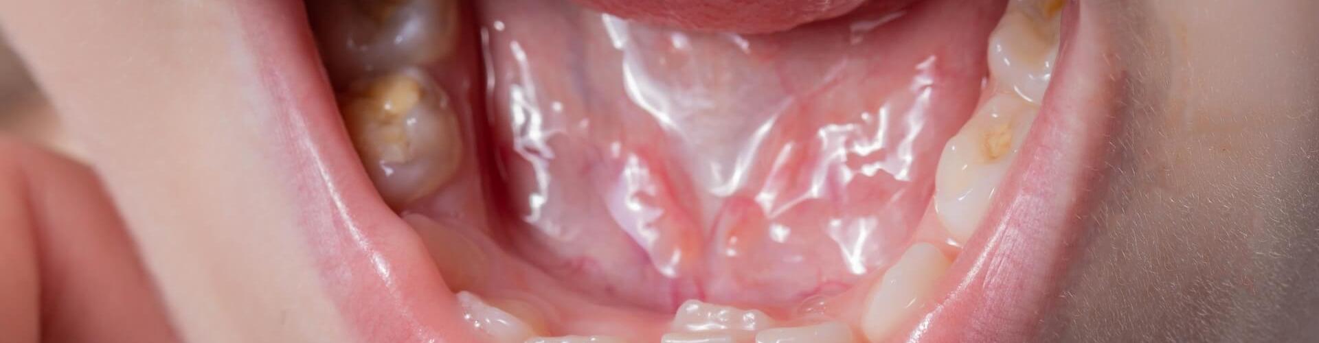 dente cresciuto in seconda fila nella bocca di un bambino