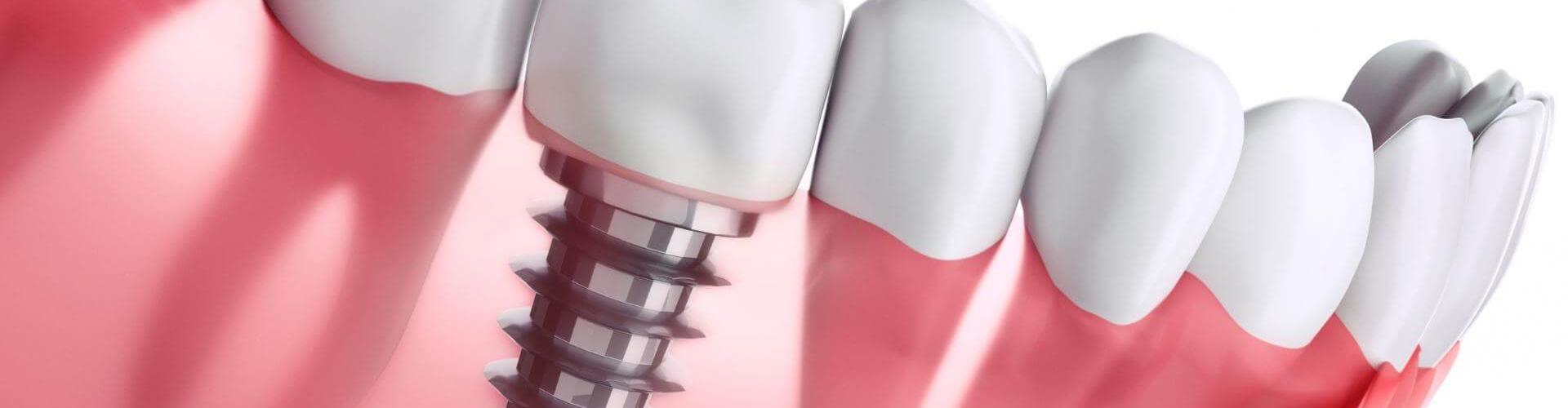 impianti dentali: impianto a carico immediato