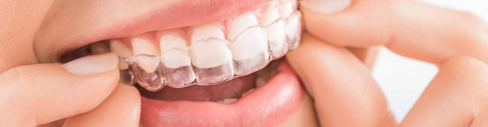 aligner trasparenti dentali