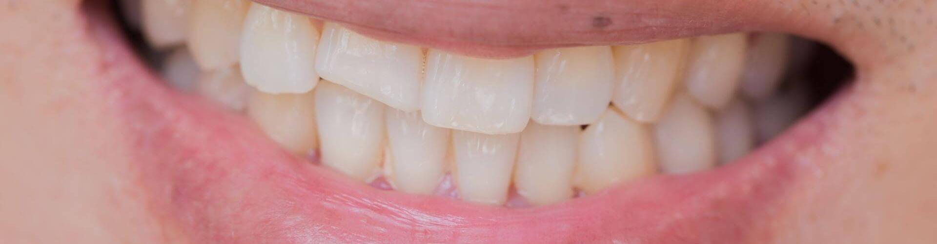 denti scheggiati: ricostruzioni dentali dirette