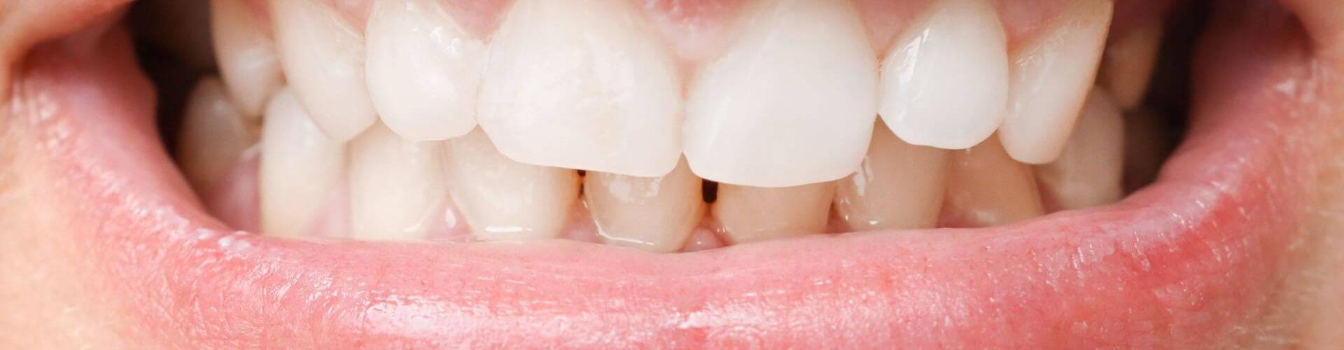 chiusura dei denti disequilibrata