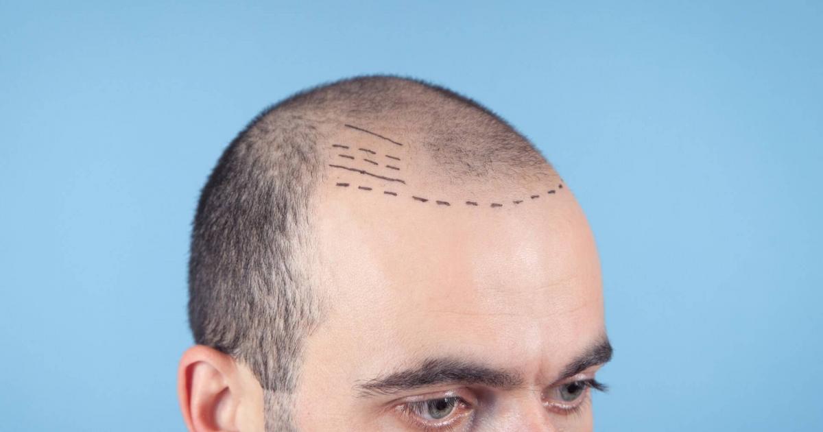 Trapianto Di Capelli In Albania? 4 Motivi Per Cui Dovresti Sceglierlo - Foto 3